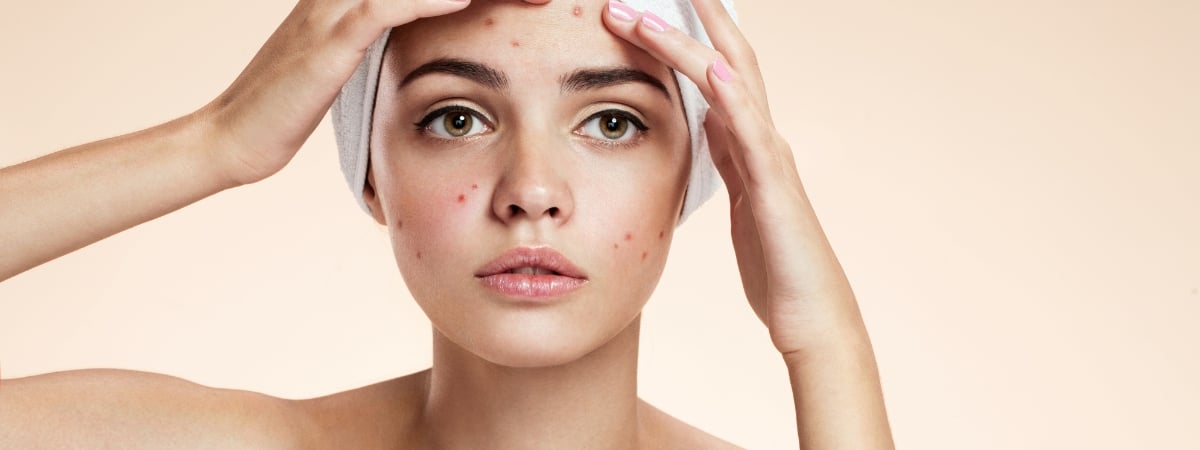 Targeting acne and problem-prone skin with Environ Skin Care
